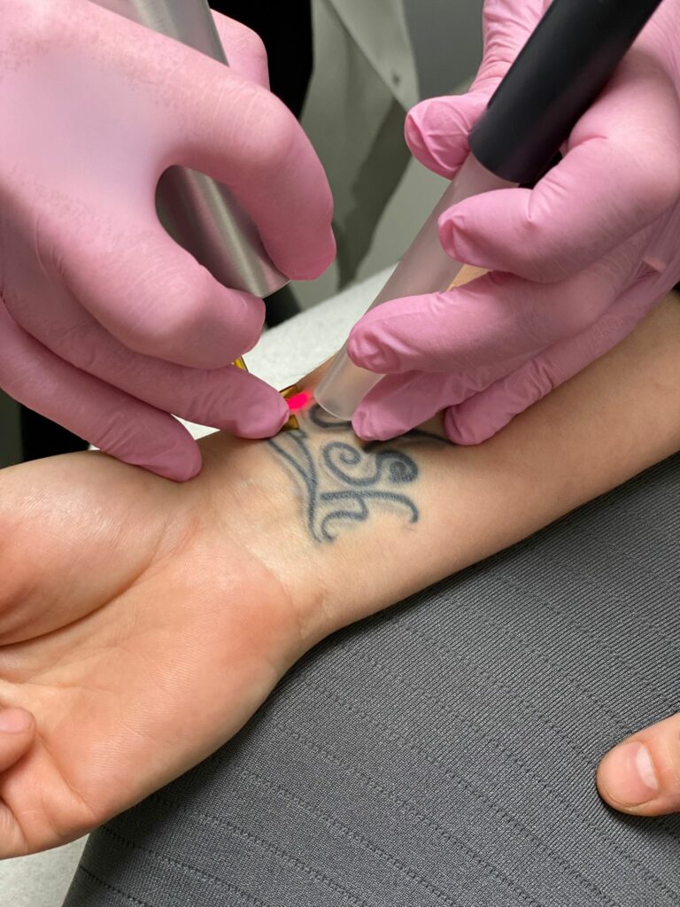 tatoeage verwijderen